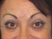 Brow Lift after 541478