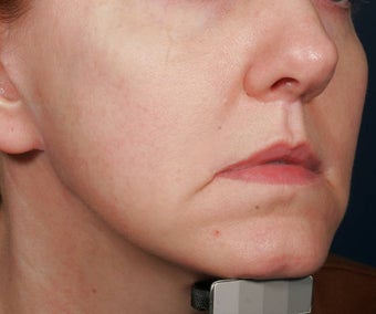 Fraxel Repair before 136853