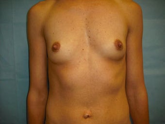Breast Implants before 137925