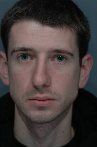 Rhinoplasty before 292546