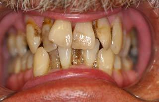 Dental Implants before 510550