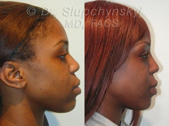 African American Rhinoplasty before 609011