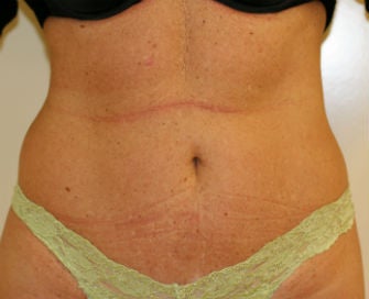 Mini-abdominoplasty after 493653