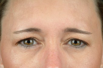 Botox after 531606