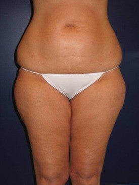 Liposuction of abdomen, hips, knees, and inner and outer thighs before 592900