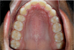 Braces and Extraction after 349028