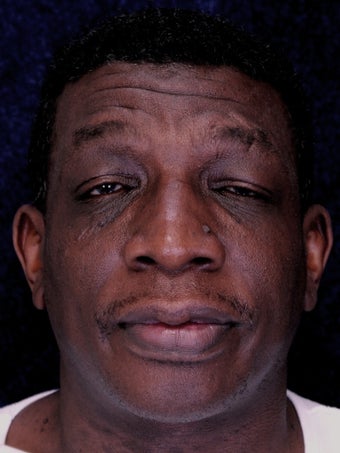 Rhinoplasty before 396370