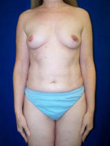 Extra Large Breast Augmentation Surgery before 125016