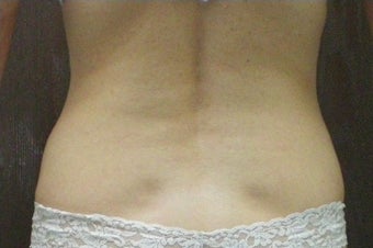 Lipo for Back and Love Handles after 374881