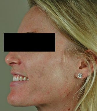 Laser Acne Treatment after 82951