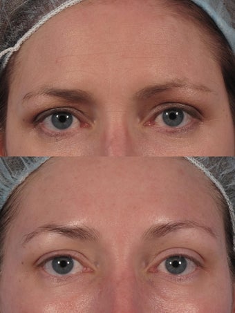 Botox to glabella and "crow's lines" before 174931