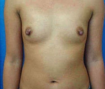 Breast Augmentation before 317789