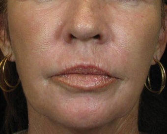 C02 Results on Aging Female Face after 628475