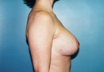 Vertical Mastopexy (Breast Lift) w/ Saline Implants after 247613