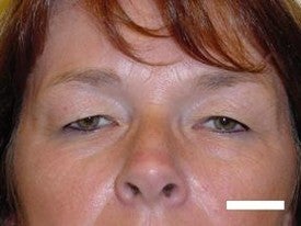 Blepharoplasty before 252432