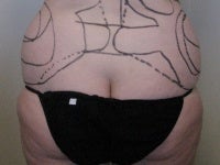 Liposuction before 272088