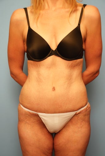 Tummy Tuck without muscle tightening after 259127