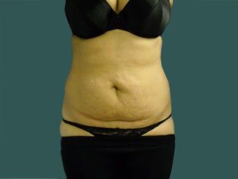 Tummy tuck before 561249