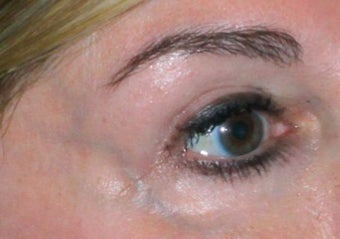 Laser vein removal 374354