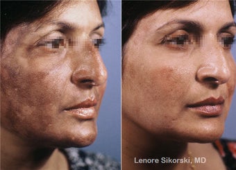 Hyperpigmentation Correction before 106303