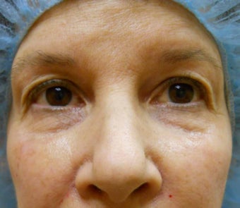 Under-Eye Filler Treatment after 567434