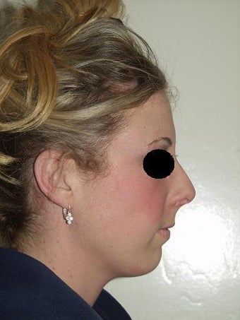 Chin implant before 209458