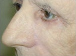 Eyelid and cheek skin cancer reconstruction after 84507