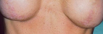 Breast implant scar removal after 376104