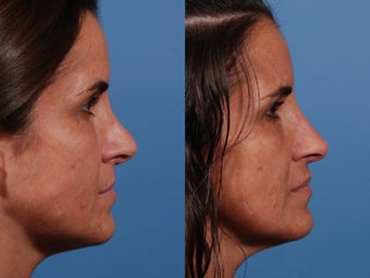 Revision rhinoplasty after 435954