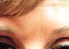 Botox after 341047