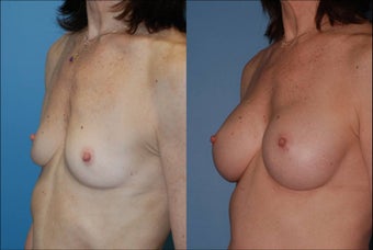 Breast Augmentation - Silicone after 127492