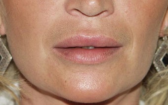 Lip Augmentation after 203774