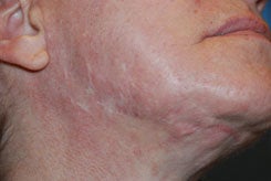 Acne Scar Treatment with Surgical Excisions and Geometric Line Closures. before 562082