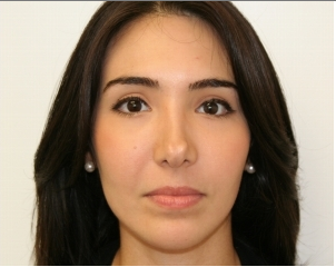 Facial Rejuvenation with Soft tissue fillers after 414179