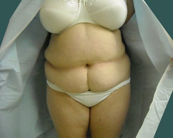 Extended abdominoplasty before 561153