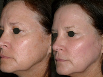 Juvia fractional CO2 resurfacing before 86772