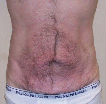 VASER Shape to Abdomen after 433039
