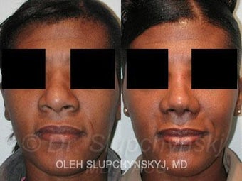 African American Rhinoplasty before 374017