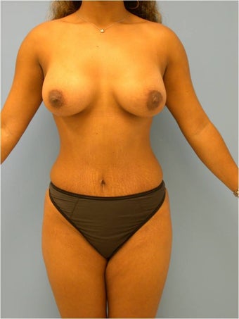 Bikini Tummy Tuck after 241923