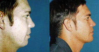 Chin Augementation before 633456