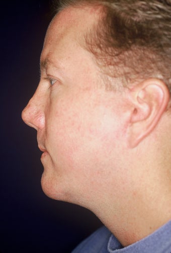Chin Implant after 551169