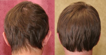 Otoplasty or ear push back surgery before 583658