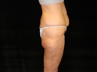 Body Lift with Liposuction of Abdomen, Waist, and Flanks before 203470