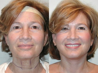 SLUPlift Neck & Jowl Lift before 216833