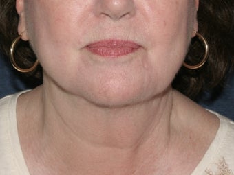 Liposculpture after 486632