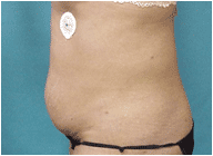 true tumescent lipo before 269160