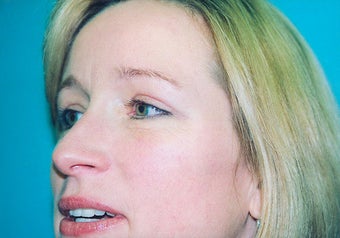 Eyelid Surgery (Blepharoplasty) after 265347