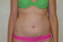 Liposuction before 177564