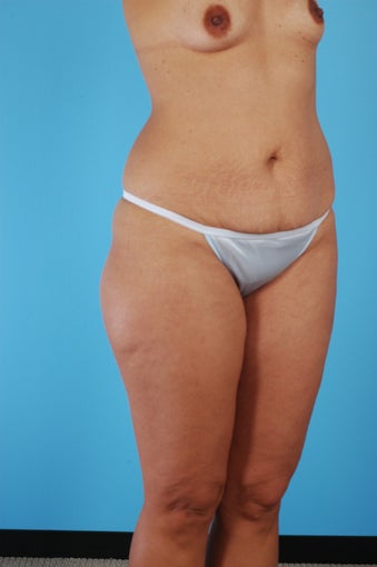 Tummy Tuck, Liposuction, Breast Augmentation before 458976