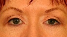 Upper Blepharoplasty (Upper Eyelids) after 376859
